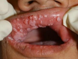 human papillomavirus infection tongue
